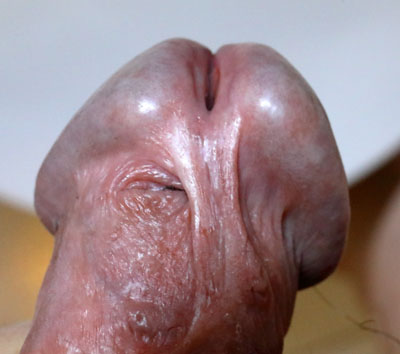 gland décalotté